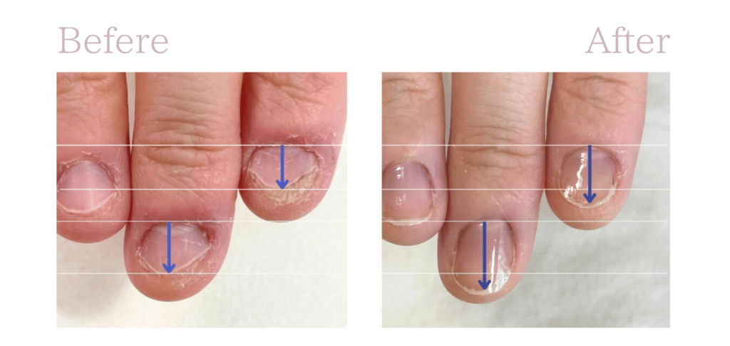 自爪育成ケアのビフォーアフターです